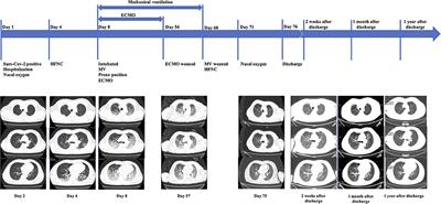 Case Report: Respiratory Management With a 47-Day ECMO Support for a Critical Patient With COVID-19